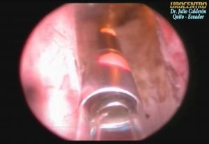 CIRUGIA LASER DE PROSTATA