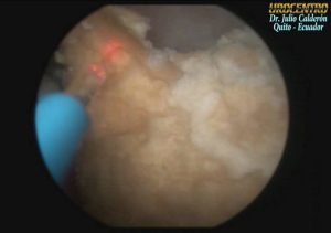 LITOTRIPSIA EXTRACORPOREA (NO INVASIVA).